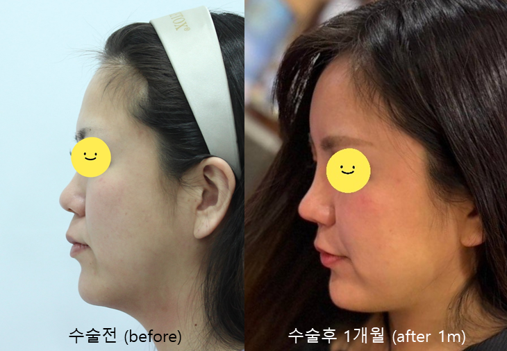 Forehead Fat Grafting for a More Youthful Face image 6