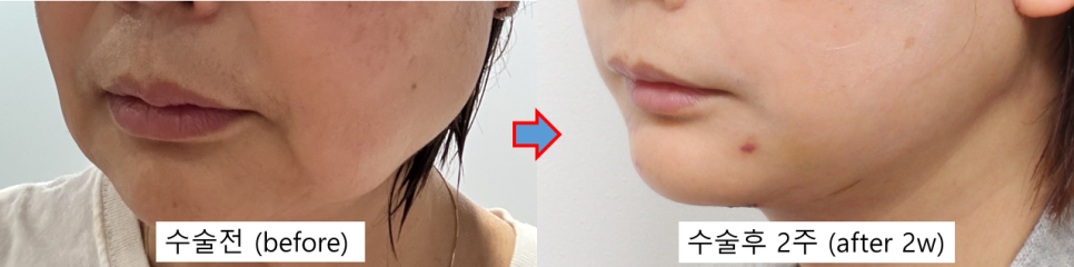 입가 주름 리프팅, 마리오네트 라인 개선하는 방법 관련 이미지 5