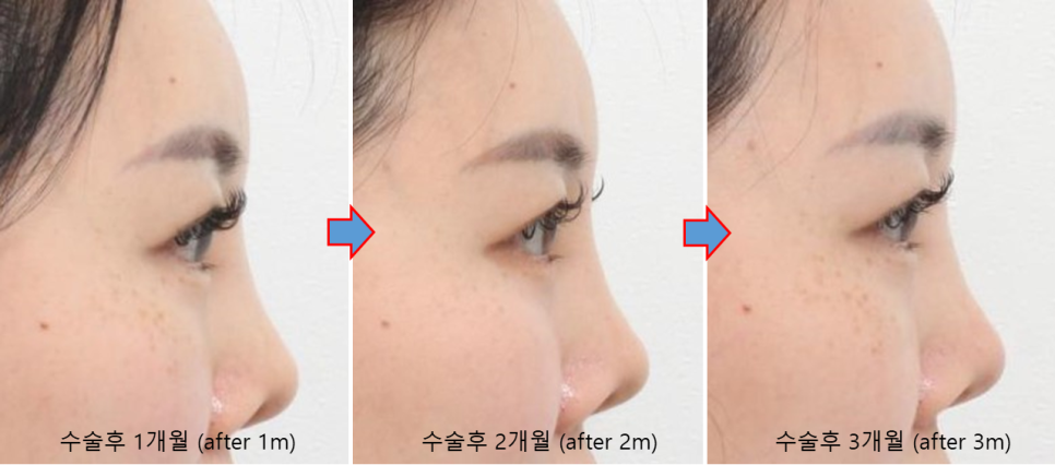 늑연골로 만든 콧대, 정말 흡수될까요? 관련 이미지 5