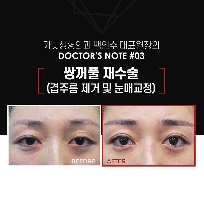 【가넷성형외과 백인수원장 성형칼럼】 쌍꺼풀재수술 (겹주름제거와 눈매교정술) 케이스 관련 이미지 2