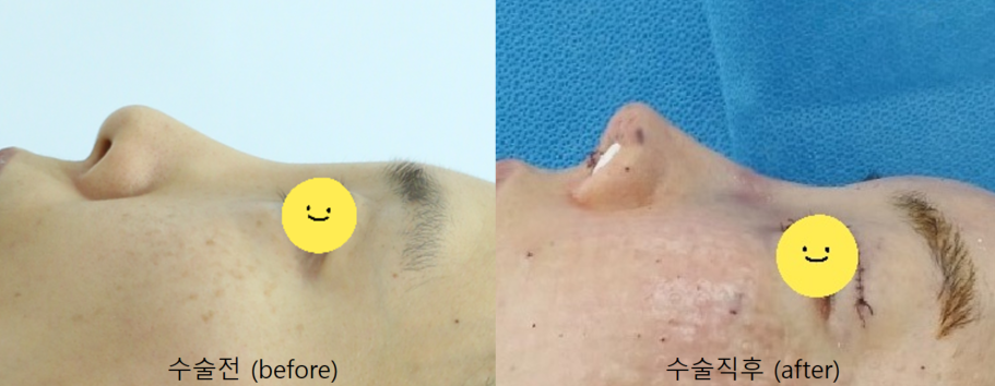 오래된 코필러를 녹이면서 시행하는 코성형 관련 이미지 10