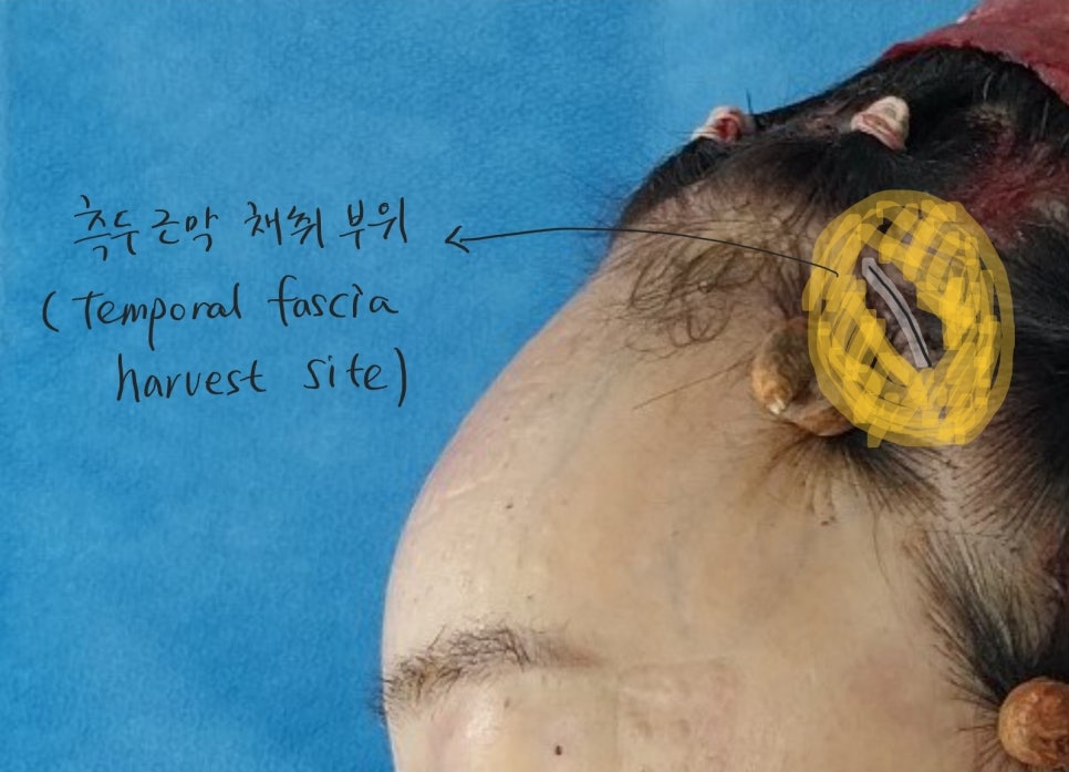 코끝연골이 비치는 경우 중년코재수술 관련 이미지 4