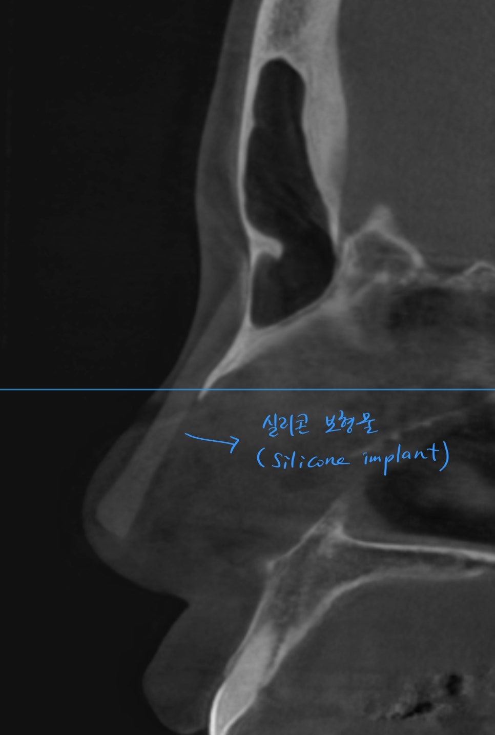늑연골을 이용한 비주함몰의 교정 관련 이미지 5