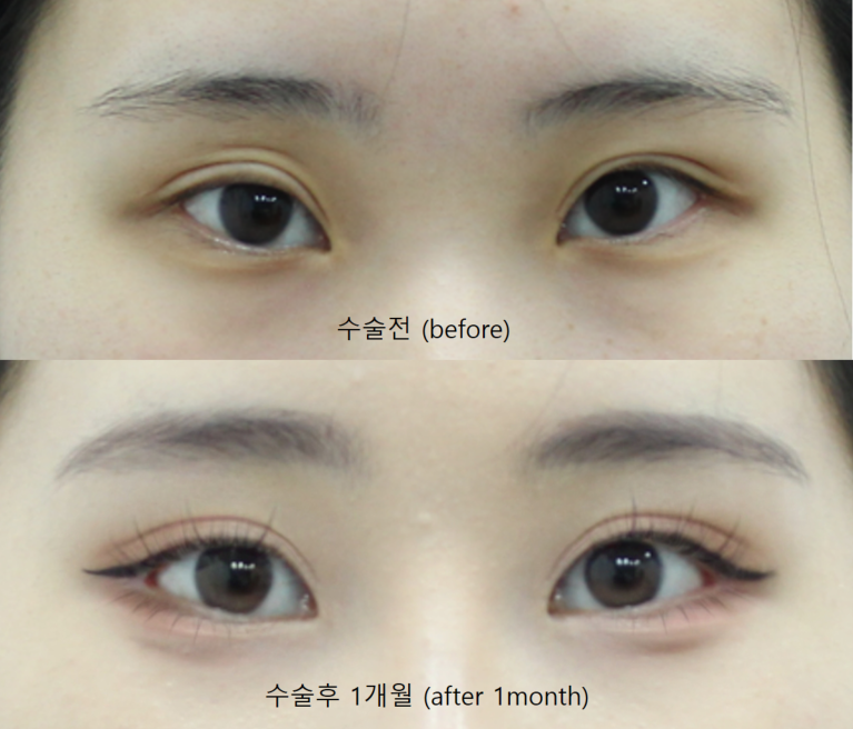 안검하수가 동반된 짝눈의 쌍꺼풀 재수술 관련 이미지 8