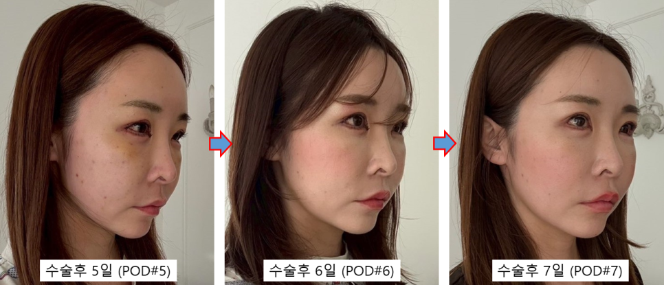 동안과 여성스러움을 동시에, 자연스러운 변화를 만드는 지방이식 관련 이미지 4