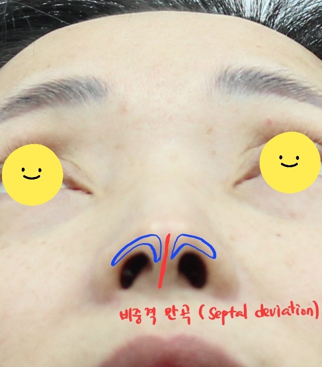 휜코와 동반된 매부리코의 교정 관련 이미지 3
