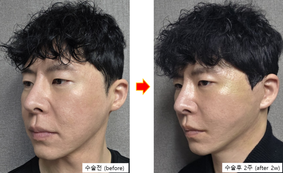 남자 안면거상, 구렛나루를 지키는 것이 중요한 이유 관련 이미지 4