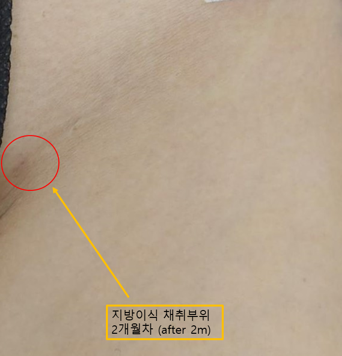 눈주변 지방이식, 채취부터 이식까지 섬세하게 진행되는 자연스러운 변화 관련 이미지 2