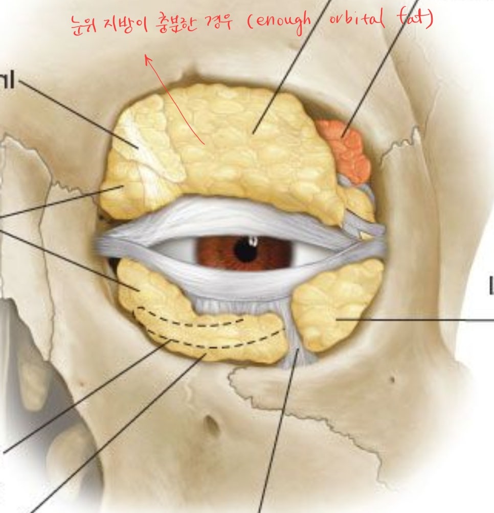 Upper Eyelid Surgery with Upper Eyelid Fat Repositioning image 2