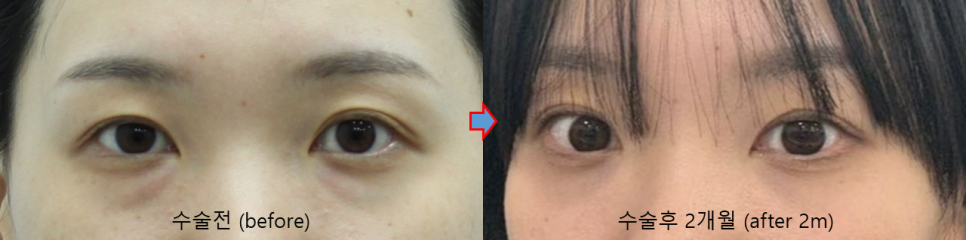 다크서클 없애는 수술, 하나만 꼽는다면? 눈밑지방재배치의 효과 관련 이미지 2