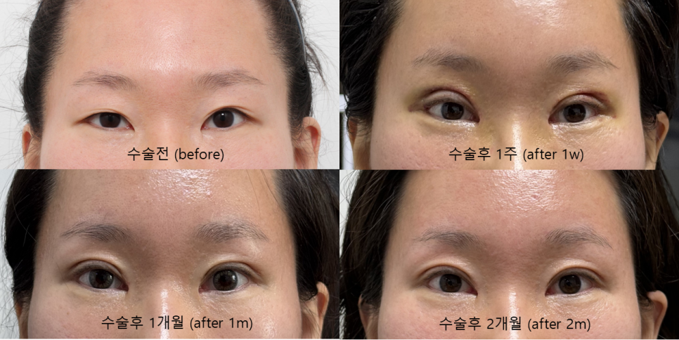 Why Forehead Lift and Double Eyelid Surgery Are Performed Together in Younger People image 2