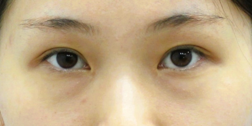Under-Eye Fat Repositioning and Aegyo-Sal Fat Grafting image 2
