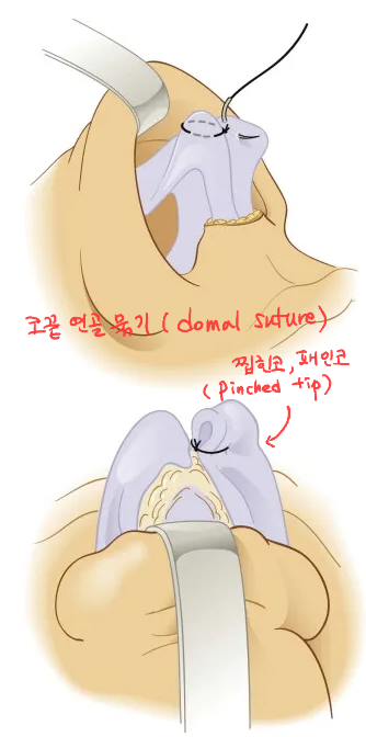Correction of a Pinched Nose or Indented Nose image 3