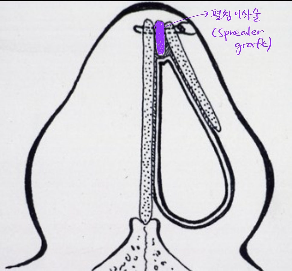 Rib Cartilage Rhinoplasty for a Deviated Saddle Nose image 8