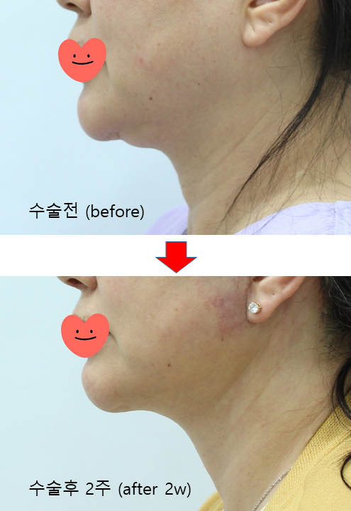 Submental Incision Neck Lift Performed Together with Facelift image 9