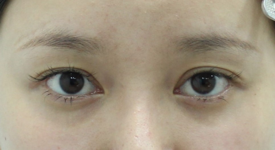 Molding in Micro-Fat Grafting for Aegyo Sal image 1
