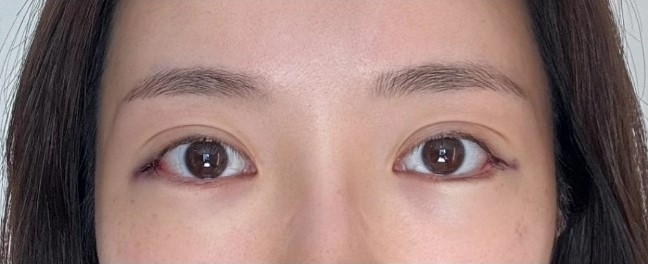 눈 아래부분을 화려하게 만드는 눈성형 관련 이미지 6