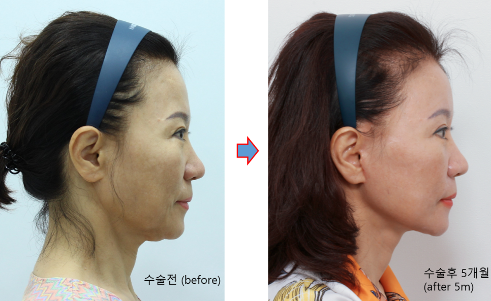 After a Face Lift, When Will Swelling and Bruising Go Away? Recovery Process and Natural Results image 7