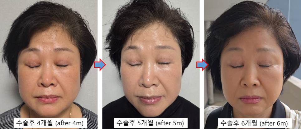 쌍꺼풀 재수술, 함몰흉터는 개선되고 눈은 편해졌습니다 - 6개월 흉터 성숙 과정 관련 이미지 4