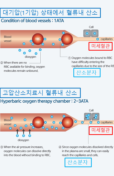 배우 이미숙도 경험한 고압산소치료, 왜 주목받고 있을까요? 관련 이미지 3