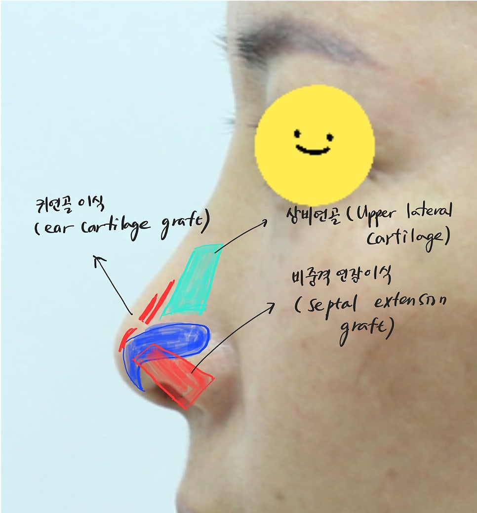 The Aging Process of the Nose and Midlife Rhinoplasty image 7