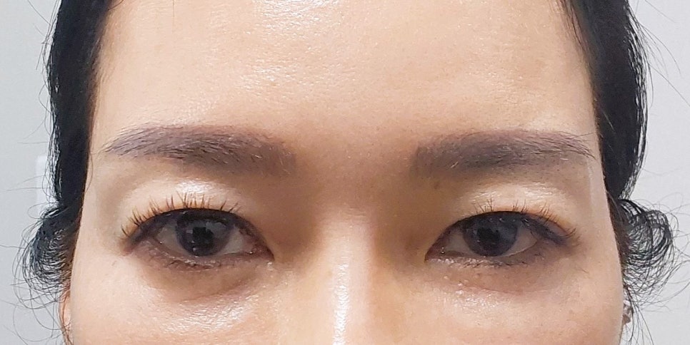 쌍꺼풀 수술 없이 쌍꺼풀이 다시 보이는 이유 관련 이미지 1