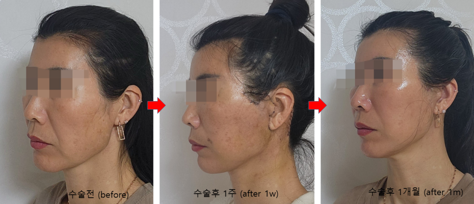 How a Facelift Changes Face Shape image 5