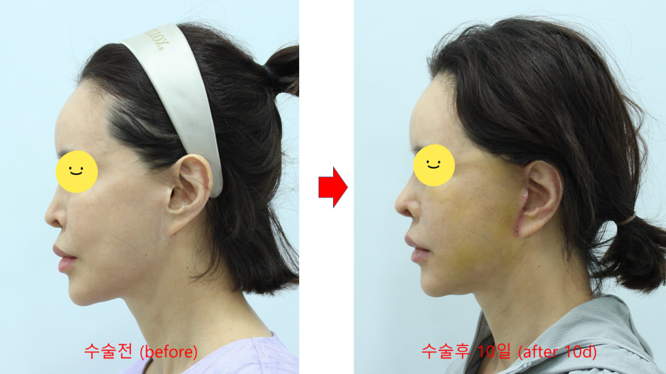 딥 미니거상을 통한 이주의 재건 관련 이미지 4