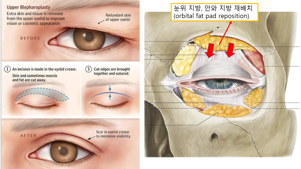 How to Address Double Eyelids and Hollow Eyes by Improving Both the Line and Volume image 1