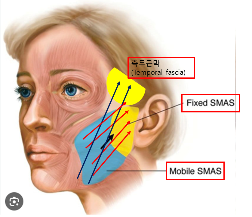 Natural Thread Lifting Using the Face’s Glide Planes image 3