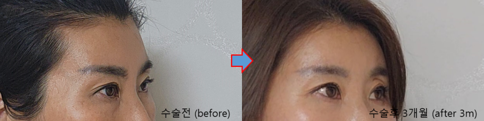 꺼진 관자와 납작한 이마, 지방이식으로 부드러운 인상 변화 관련 이미지 6