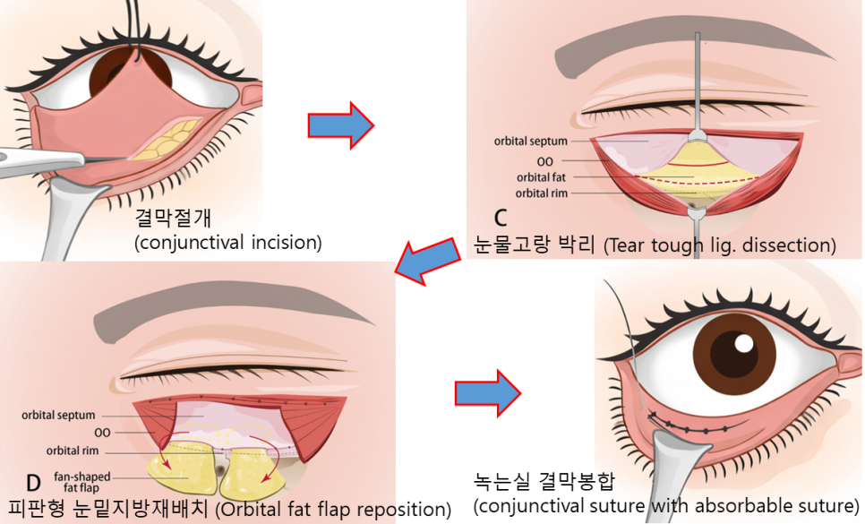 이영지 눈밑지방재배치, 시술일까 수술일까? 관련 이미지 3
