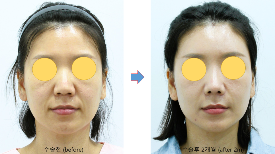 Areas of the Face Improved by a Deep Mini Facelift image 6