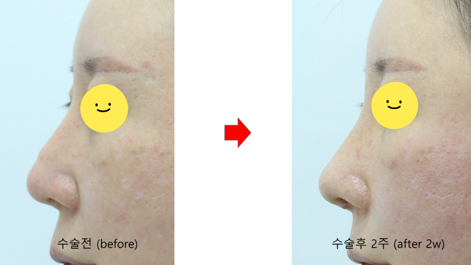 콧대에 실리콘 보형물을 늑연골로 대체하는 경우 관련 이미지 8