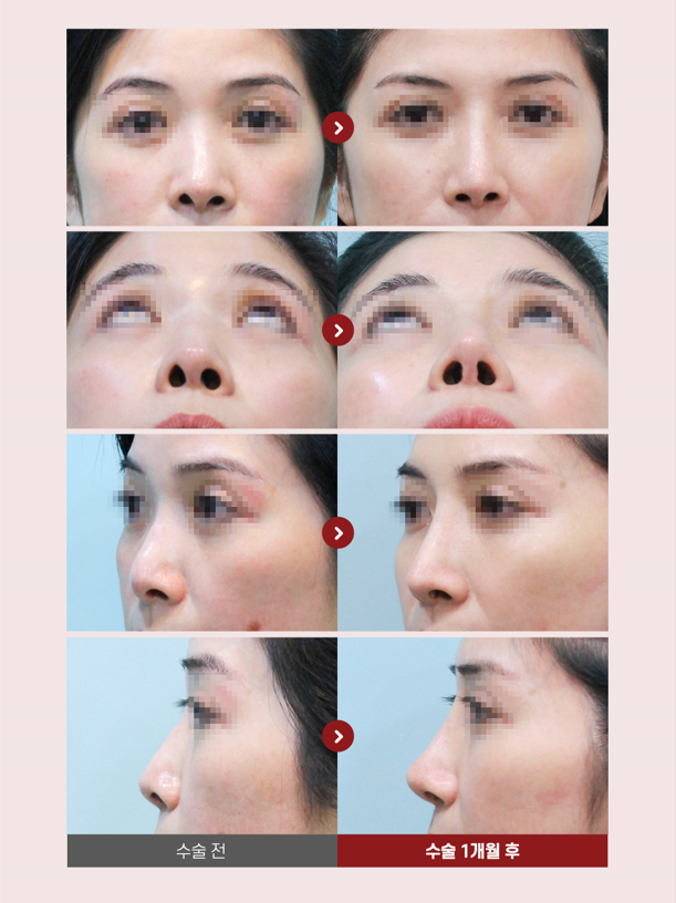 【Garnet Plastic Surgery Director Baek In-soo’s Plastic Surgery Column】 Facial Asymmetry and Crooked Nose Surgery image 6