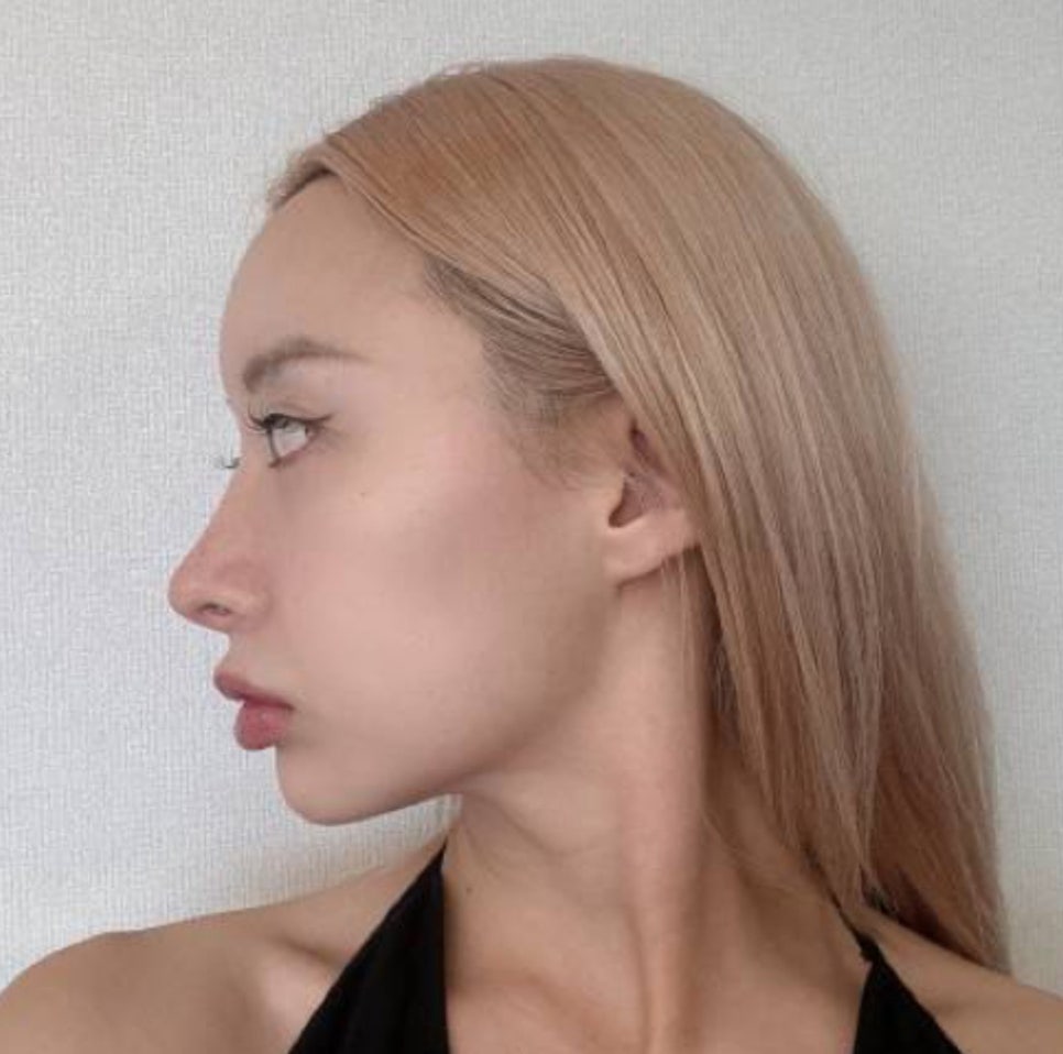 Rhinoplasty for Zainichi Koreans, Rhinoplasty for Japanese Koreans image 9