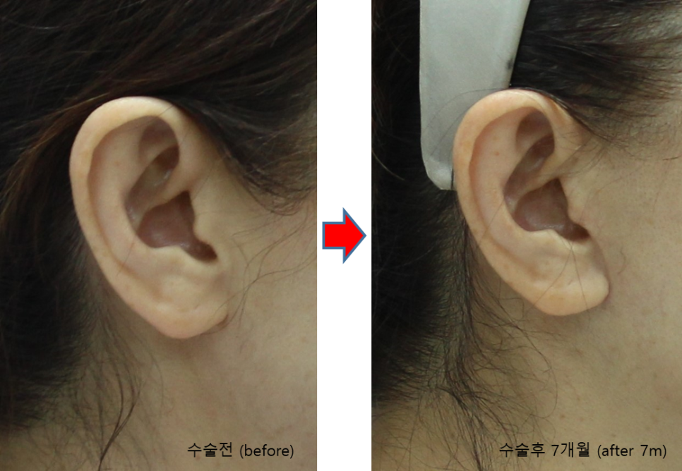안면거상, 긴 절개선인데 흉터가 눈에 잘 띄지 않는 이유 관련 이미지 6