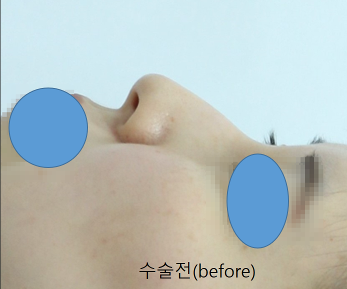 자연스러운 변화를 위한 무보형물 코성형 관련 이미지 1