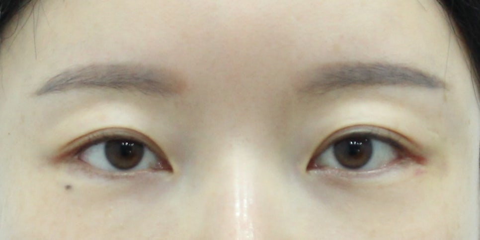 Non-incisional Eye Correction in Revision Surgery for Buried-Method Double Eyelids image 2