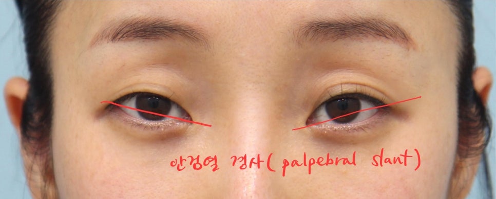 쌍꺼풀 수술과 함께 착한 이미지를 만드는 눈매교정 관련 이미지 1
