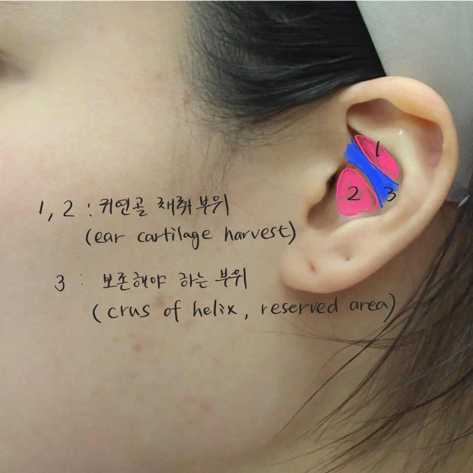 Precautions When Using Ear Cartilage in Rhinoplasty image 1