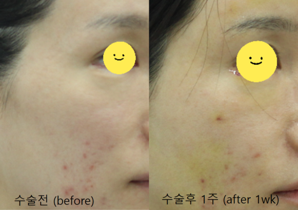 A Specialized Fat Grafting Correction Method for Hollowed Side Cheeks image 8
