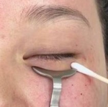 Molding in Micro-Fat Grafting for Aegyo Sal image 2
