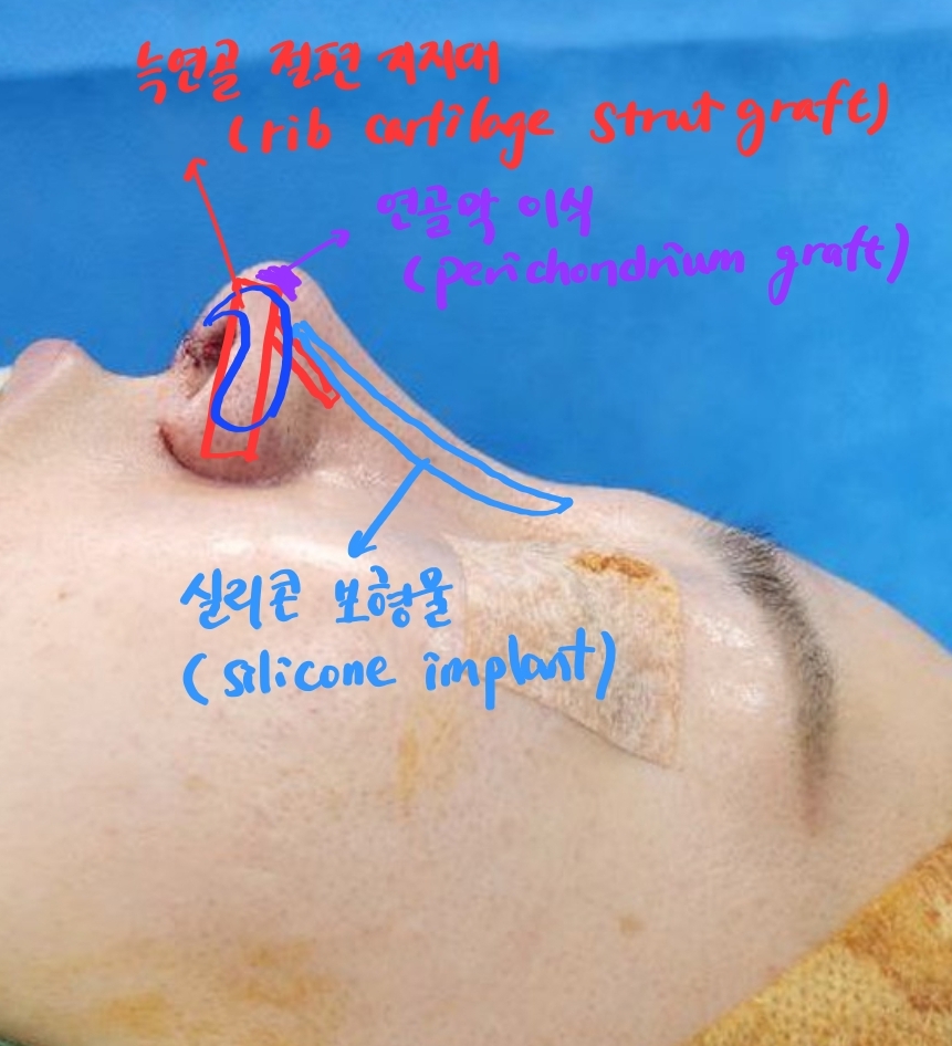 자가늑연골을 이용한 코 재수술 관련 이미지 6