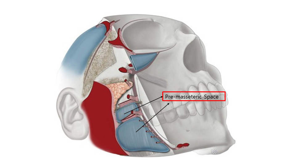 Natural Thread Lifting Using the Face’s Glide Planes image 2