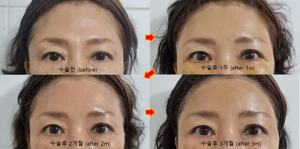 안티에이징 수술과 함께, 수면마취 중 스킨부스터까지 한번에 관련 이미지 2
