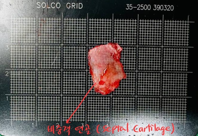 코재수술에서 얇아진 피부를 보강하는 방법 관련 이미지 3