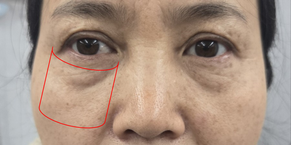 하안검 수술, 어디까지 변화하고 있을까? 관련 이미지 3