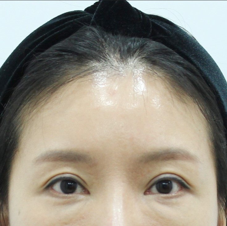 Forehead Lift After Upper Blepharoplasty image 10