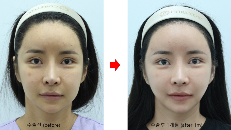 Sagging Skin After Facial Contouring Surgery (Cheek Sagging) image 8